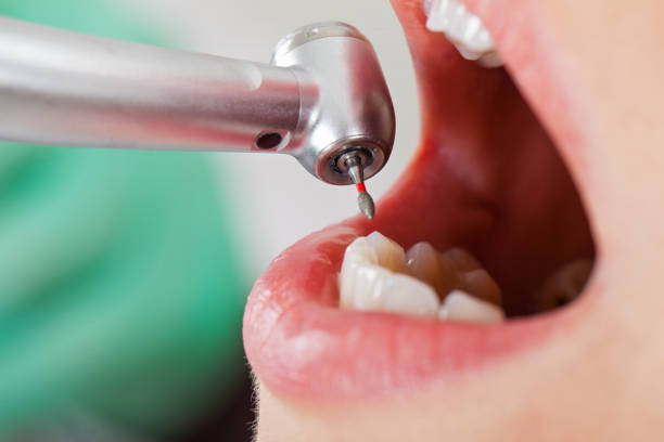Best Emergency Wisdom Tooth Extraction in Singac, NJ